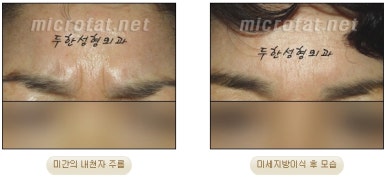 Duhan Plastic Surgery Wrinkle Improvement - Glabellar Horizontal Wrinkles, Glabellar Straight Wrinkles, Glabellar Wrinkle Surgery image 9