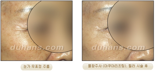 Duhan Plastic Surgery Wrinkle Improvement - Wrinkle Fillers, Juvederm image 13