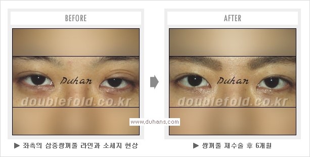 [두한성형외과 경쟁력 쌍꺼풀 재수술, 극한 눈재수술] - [망친 쌍꺼풀, 망가진 쌍꺼풀 복원수술, 재수술의 성공요건] 관련 이미지 14