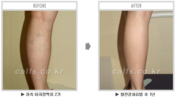 [종아리성형 두한성형외과] - [종아리수술에 대한 자주하는 질문과 답변 모음] 관련 이미지 5