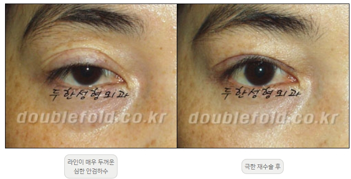 [Duhan Plastic Surgery Double Eyelid Revision] - [Thick Double Eyelid Line] image 44