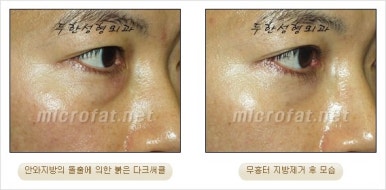 두한성형외과 눈밑수술 - 다크서클 수술 전후 관리 안내 관련 이미지 60