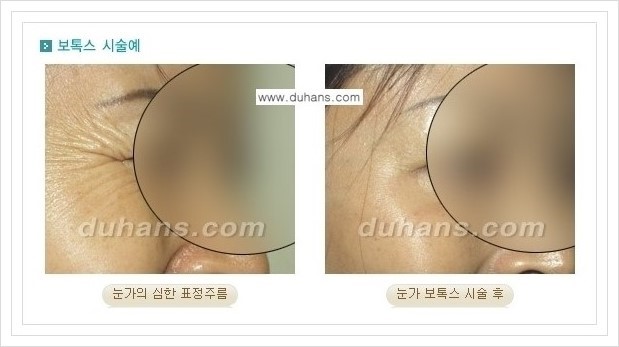 [두한성형외과 경쟁력 Quick성형] - [주름교정을 위한 간편한 보톡스(보툴리눔톡신) 시술 안내] 관련 이미지 6