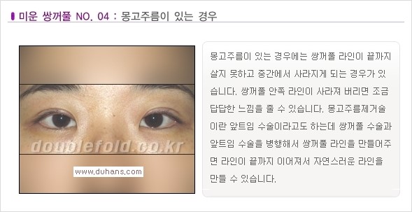 [두한성형외과 경쟁력 쌍꺼풀 재수술, 극한 재수술] - [일반적인 기준의 미운 쌍꺼풀과 아름다운 쌍꺼풀 안내] 관련 이미지 4