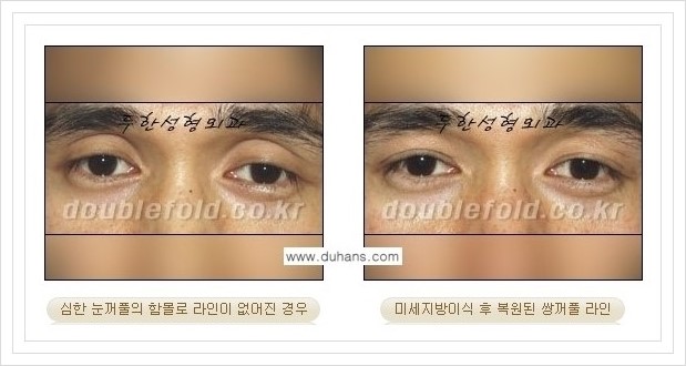 [두한성형외과 경쟁력 눈성형] - [풀린 쌍꺼풀 라인 재수술의 여러 가지 방법 안내] 관련 이미지 13