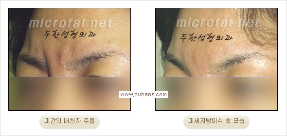 [두한성형외과 경쟁력 주름성형] - [여러 가지 주름제거 시술방법] 관련 이미지 32