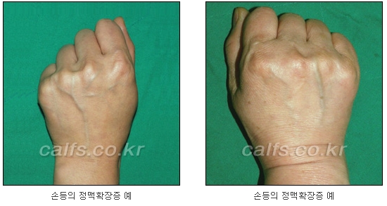 두한성형외과 보기싫은 혈관제거 - 눈밑혈관, 손과 팔의 혈관확장증 치료 관련 이미지 24
