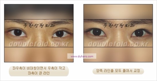 [두한성형외과 경쟁력 눈성형] - [비대칭 쌍꺼풀 라인의 여러 가지 교정 방법] 관련 이미지 11