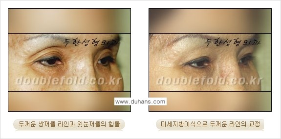 [두한성형외과 NO.1 눈성형] - [함몰된(꺼진) 눈꺼풀에서 쌍꺼풀 라인 교정 2.] 관련 이미지 13