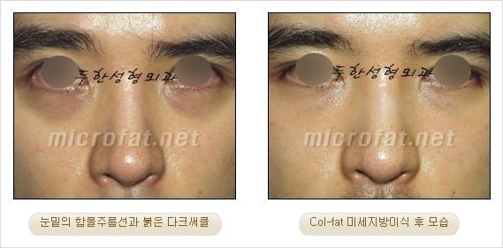​[두한성형외과 경쟁력 눈밑성형 리더] - [눈밑 다크써클의 증상, 원인, 종류, 치료방법 안내] 관련 이미지 32