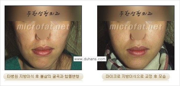 [두한성형외과 경쟁력 미세지방이식] - [타 병원에서 볼살 지방이식 이후 부작용 교정 방법 안내] 관련 이미지 6