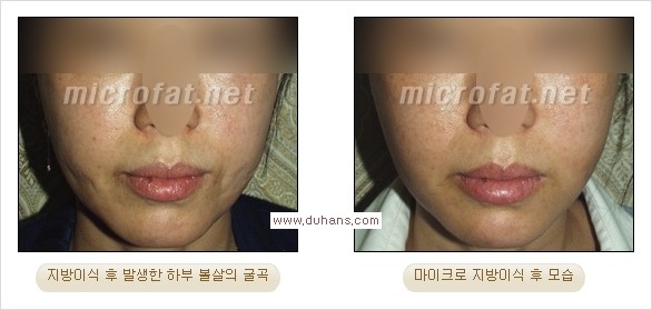 ​[두한성형외과 경쟁력 지방이식] - [지방이식 부작용 이후 마이크로 지방흡입, 마이크로 지방흡입 이후 부작용 없는 지방이식 방법] 관련 이미지 19