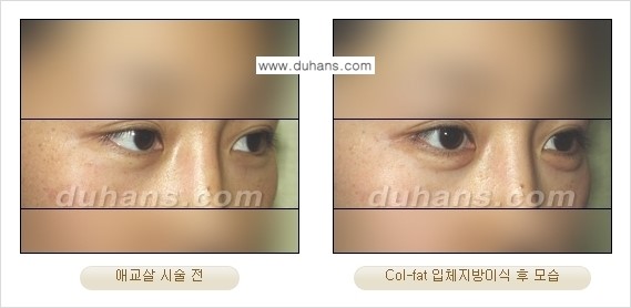 [두한성형외과 경쟁력 미세지방이식]-[Col-fat 입체지방이식 사례 안내] 관련 이미지 7