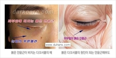 [두한성형외과 경쟁력 눈밑성형] - [다크써클의 원인과 다크써클의 종류] 관련 이미지 2