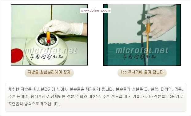 [두한성형외과 경쟁력 눈밑성형] - [눈밑 애교살 시술을 위한 미세지방이식] 관련 이미지 5