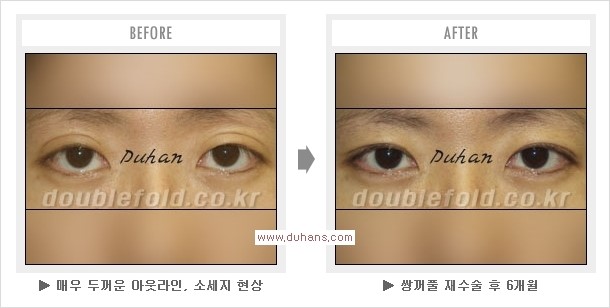 ​[두한성형외과 경쟁력 쌍꺼풀 재수술] - [아름다운 쌍꺼풀 선의 기준과 쌍꺼풀 재수술시 검사와 테스트 안내] 관련 이미지 14