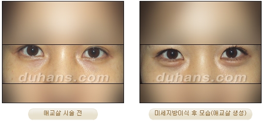 Duhan Plastic Surgery Under-Eye Surgery - Correction with Fat Grafting After Aegyo-Sal Filler image 11
