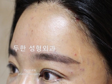 [Duhan Plastic Surgery Forehead Surgery] - [Forehead Fat Grafting for Forehead Surgery] image 18