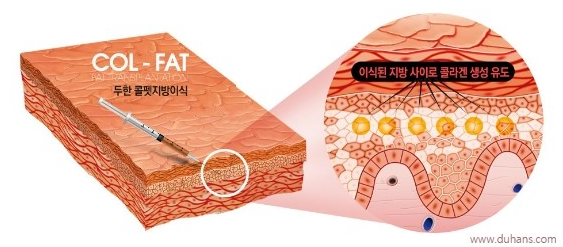 지방이식 두한성형외과 - 입가팔자주름, 인디언주름 지방이식 관련 이미지 2