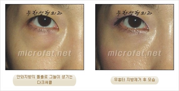 [두한성형외과 쌍커풀수술] - [눈성형 방법에 대한 자주하는 질문과 답변] 관련 이미지 170
