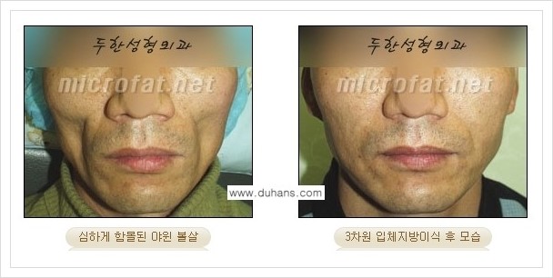 [두한성형외과 경쟁력 윤곽성형] - [볼, 볼살 지방이식] 관련 이미지 32