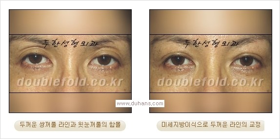 ​⁠⁠[두한성형외과 경쟁력 쌍꺼풀 재수술, 극한 눈재수술] - [지방이식으로 눈매와 쌍꺼풀 라인을 교정] 관련 이미지 8