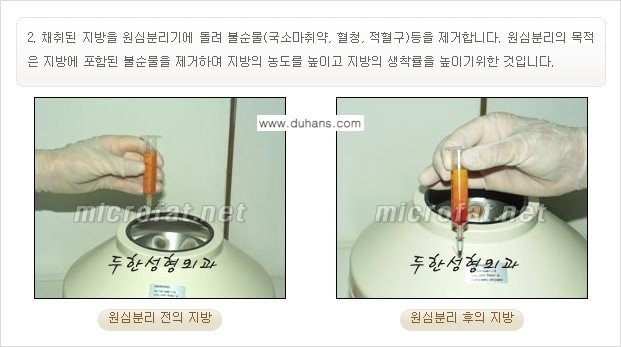 [두한성형외과의 경쟁력 있는 지방이식] - [입가주름, 팔자주름 미세지방이식 1.] 관련 이미지 3