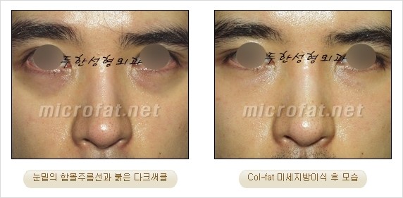 [두한성형외과 경쟁력 눈밑성형] - [Dr. 컬럼 - 눈밑 다크써클의 치료 방법과 치료 효과] 관련 이미지 12