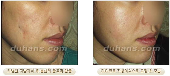 [두한성형외과 얼굴자가지방이식] - [볼살, 이마, 측두부] 관련 이미지 39