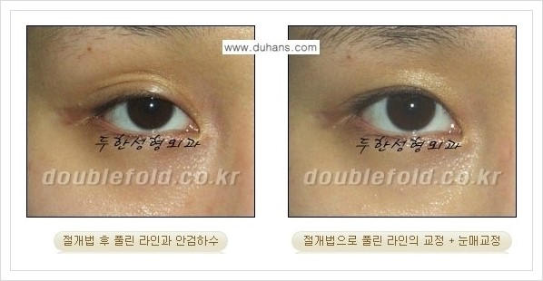 [두한성형외과 경쟁력 쌍꺼풀 재수술(극한 재수술)] - [라인이 풀렸을 경우의 쌍꺼풀 재수술 안내 ①] 관련 이미지 8