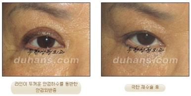 [Special Double Eyelid Revision Surgery at Duhan Plastic Surgery] - [Restorative Surgery for Damaged Double Eyelid Eye Shape] image 10