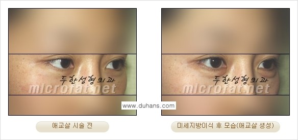 [두한성형외과 경쟁력 눈밑성형] - [눈밑 다크써클과 눈밑 애교살과의 관계 1.] 관련 이미지 8