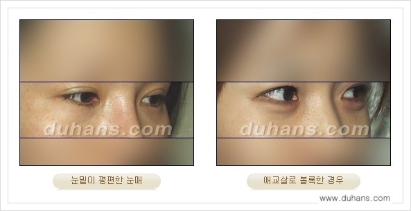 [두한성형외과 경쟁력 눈밑성형] - [눈밑 애교살 시술을 위한 미세지방이식 안내] 관련 이미지 1