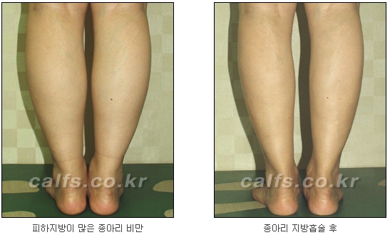 [두한성형외과 종아리성형] - [종아리 축소술 종류] 관련 이미지 11