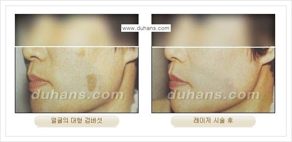 [두한성형외과 경쟁력 레이저시술] - [이산화탄소 점제거 안내] 관련 이미지 11