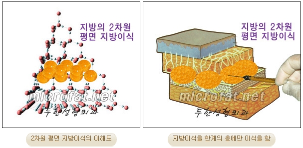 [Fat Grafting Duhan Plastic Surgery] - [Side Effects of Fat Grafting] image 4