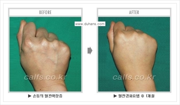 [두한성형외과 정맥류 치료] - [손, 팔 정맥확장증 사진자료 안내 ①] 관련 이미지 4