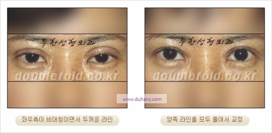 [두한성형외과 경쟁력 눈성형] - [비대칭 쌍꺼풀 라인의 여러 가지 교정 방법] 관련 이미지 16