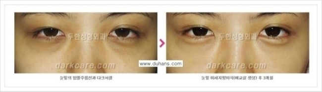 [두한성형외과 경쟁력 눈밑성형] - [눈밑애교살 시술을 위한 미세지방이식] 관련 이미지 23