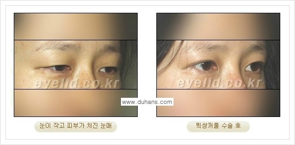 [두한성형외과 경쟁력 눈성형] - [퀵쌍꺼풀 수술] 관련 이미지 13