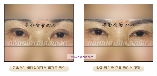 [두한성형외과 경쟁력 눈성형] - [비대칭 쌍꺼풀 라인의 여러 가지 교정 방법] 관련 이미지 14