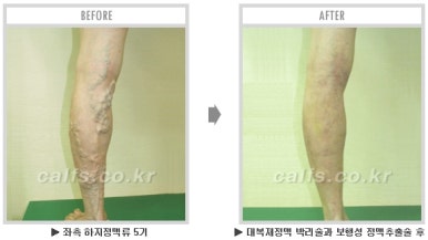 [종아리 두한성형외과] - [나에게 맞는 종아리시술] 관련 이미지 59