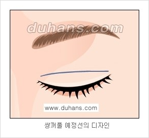 ​[두한성형외과 경쟁력 눈성형] - [자연스러운면서 매력적인 쌍꺼풀 퀵 쌍꺼풀 수술 안내] 관련 이미지 4