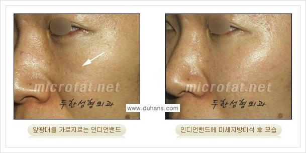 [두한성형외과의 경쟁력 미세지방이식] - [귀족수술 + 인디언밴드 미세지방이식 안내] 관련 이미지 12