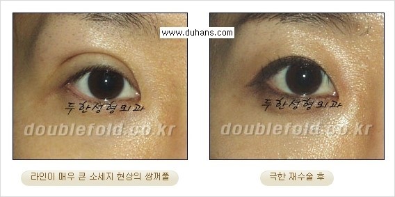 [두한성형외과 경쟁력 쌍꺼풀 재수술, 극한 눈재수술] - [망가진 쌍꺼풀 라인을 교정하는 극한 재수술을  위한 계획] 관련 이미지 13