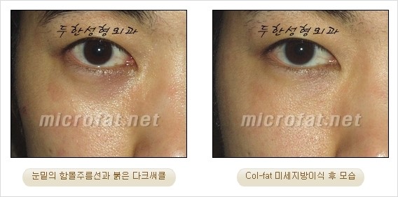 ​[두한성형외과 경쟁력 눈밑성형 리더] - [눈밑 다크써클의 증상, 원인, 종류, 치료방법 안내] 관련 이미지 22