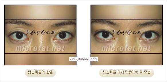 [두한성형외과 경쟁력 쌍꺼풀 재수술, 극한 눈재수술] - [어색한 쌍꺼풀 라인을 교정하는 윗눈꺼풀 미세지방이식] 관련 이미지 11