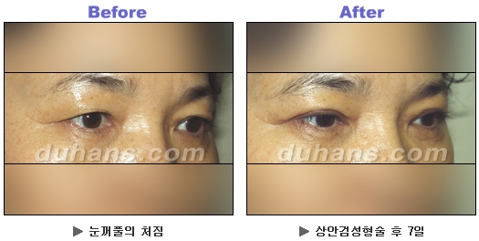 [두한성형외과 안검성형] - [상안검, 하안검] 관련 이미지 11