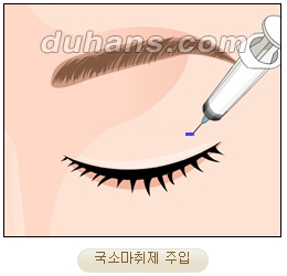 두한성형외과 지방제거 - 눈밑지방, 눈꺼풀지방제거 관련 이미지 4