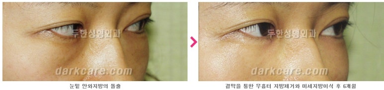 [두한성형외과 다크서클] - [다크서클 전후사진 검증] 관련 이미지 96
